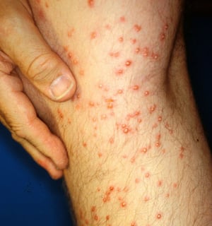 Fire ant stings on leg